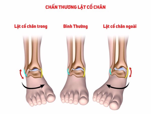 Có cần phải đến bác sĩ sau khi bị lật sơ mi không?